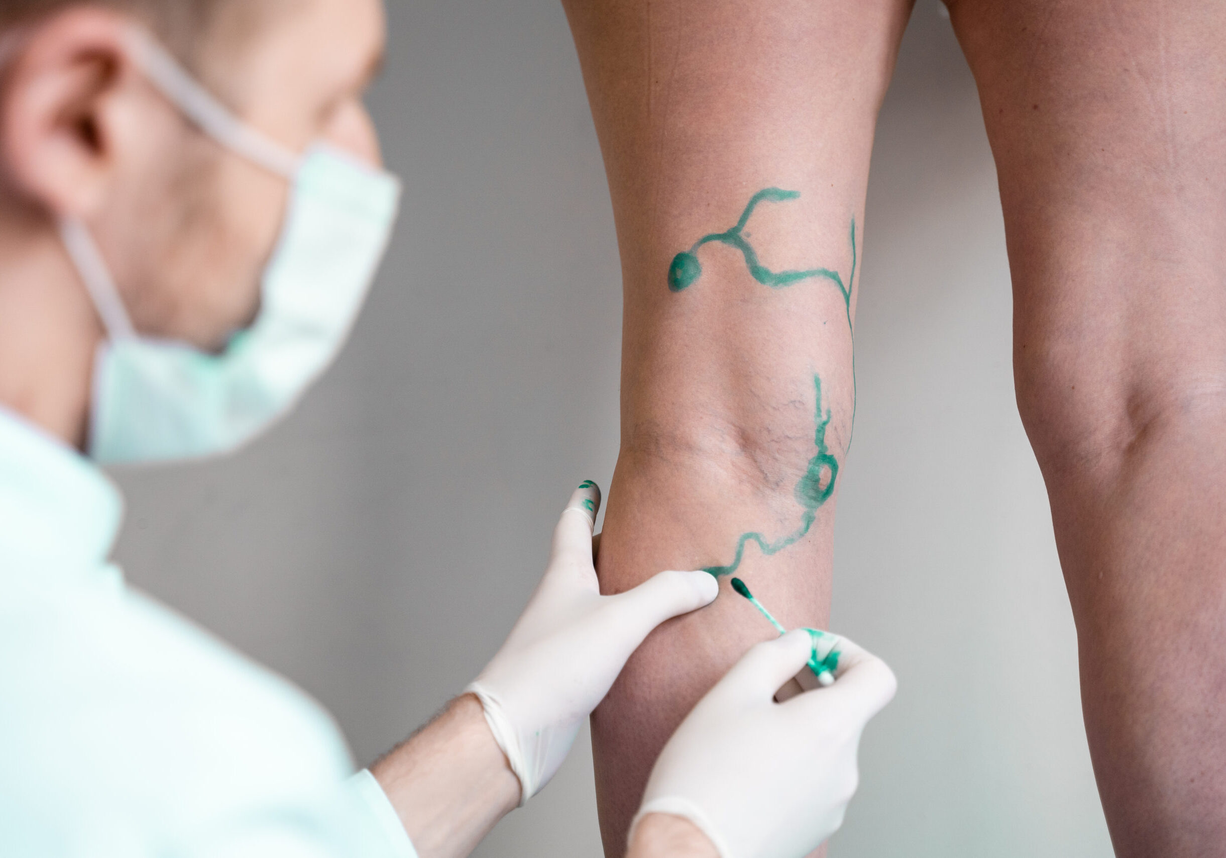 Vein,Markup.,Vascular,Surgeon,Is,Marking,Veins,For,Varicose,Surgery.